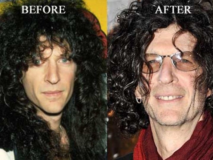 Howard Stern before and after plastic surgery