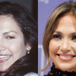 Jennifer Lopez before and after plastic surgery 01