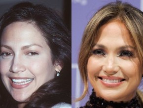 Jennifer Lopez before and after plastic surgery 01