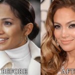 Jennifer Lopez before and after plastic surgery 02