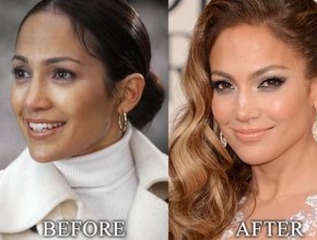 Jennifer Lopez before and after plastic surgery 02