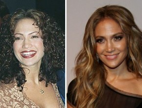 Jennifer Lopez before and after plastic surgery 03
