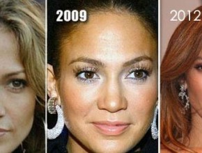 Jennifer Lopez before and after plastic surgery 07