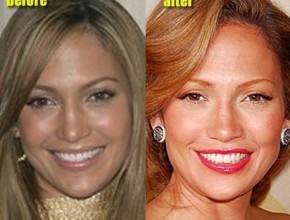 Jennifer Lopez before and after plastic surgery 08