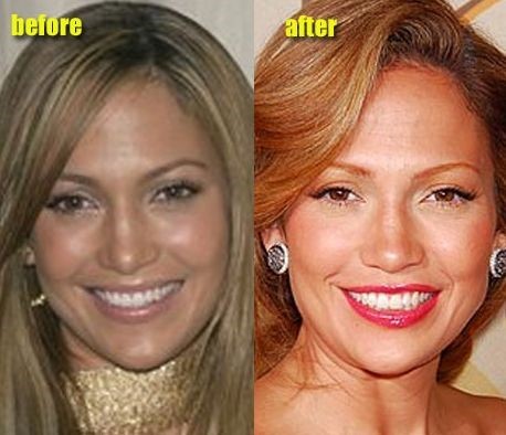 Jennifer Lopez before and after plastic surgery 08