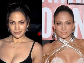 Jennifer Lopez before and after plastic surgery 09