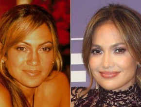 Jennifer Lopez before and after plastic surgery 10