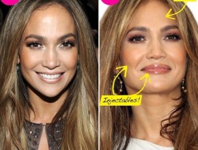 Jennifer Lopez before and after using botox 01