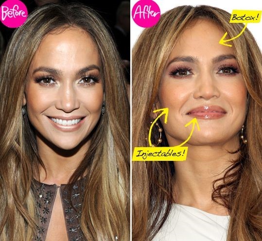 Jennifer Lopez before and after using botox 01