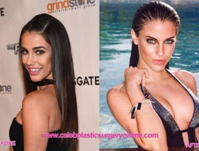 Jessica Lowndes before an after breast augmentation