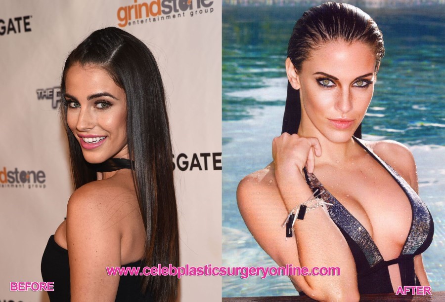 Jessica Lowndes before an after breast augmentation