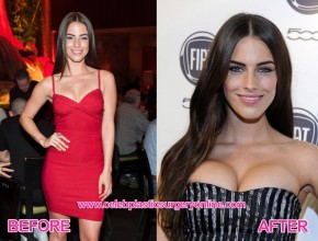 Jessica Lowndes before an after plastic surgery