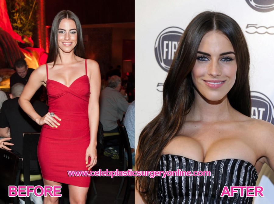 Jessica Lowndes before an after plastic surgery