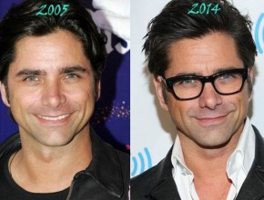 John Stamos before and after plastic surgery 08