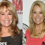 Kathie Lee Gifford before and after plastic surgery 03