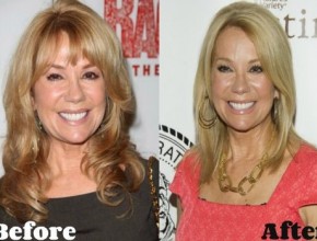 Kathie Lee Gifford before and after plastic surgery 03