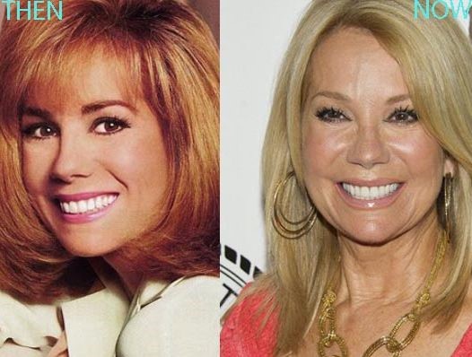 Kathie Lee Gifford before and after plastic surgery