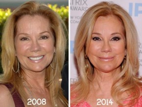 Kathie Lee Gifford before and after plastic surgery