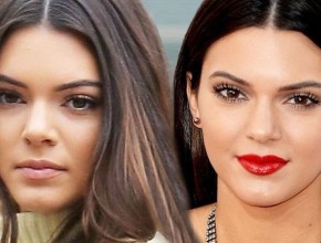Kendall Jenner before and after plastic surgery 01