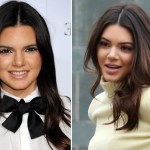 Kendall Jenner before and after plastic surgery 02