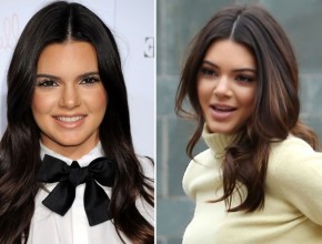 Kendall Jenner before and after plastic surgery 02