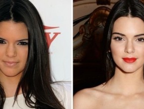 Kendall Jenner before and after plastic surgery