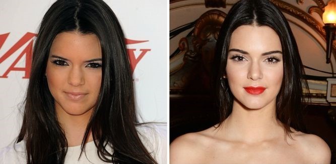 Kendall Jenner before and after plastic surgery