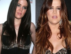 Khloe Kardashian before and after plastic surgery