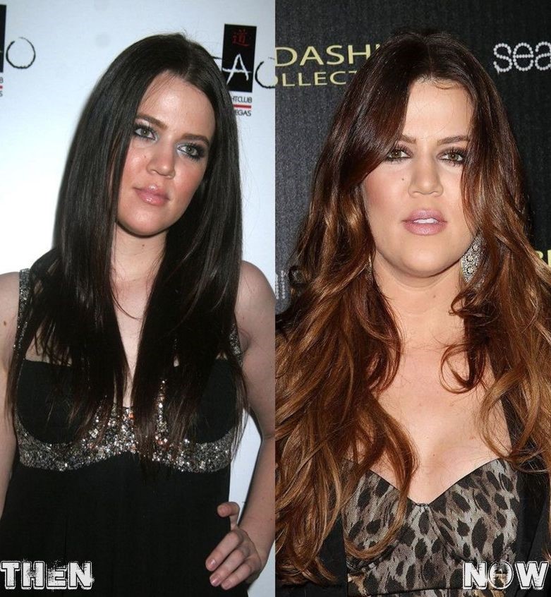 Khloe Kardashian before and after plastic surgery