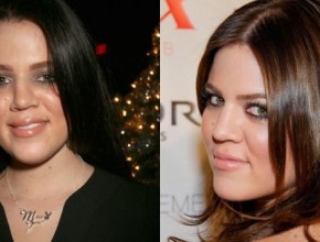 Khloe Kardashian before and after plastic surgery 01