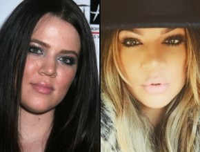 Khloe Kardashian before and after plastic surgery 02