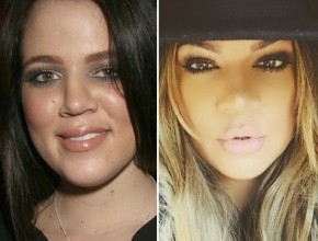 Khloe Kardashian before and after plastic surgery 05