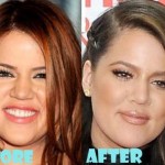 Khloe Kardashian before and after plastic surgery 06