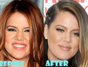 Khloe Kardashian before and after plastic surgery 06