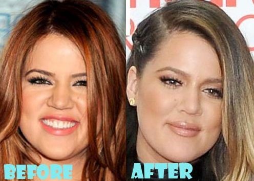 Khloe Kardashian before and after plastic surgery 06 – Celebrity ...