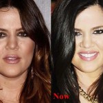 Khloe Kardashian before and after plastic surgery 07