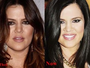 Khloe Kardashian before and after plastic surgery 07