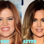 Khloe Kardashian before and after plastic surgery 08