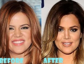 Khloe Kardashian before and after plastic surgery 08