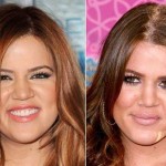 Khloe Kardashian before and after plastic surgery 09