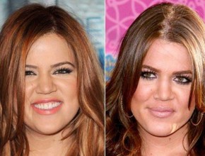 Khloe Kardashian before and after plastic surgery 09
