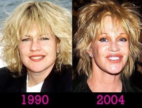 Melanie Griffith before and after plastic surgery 01