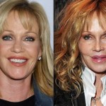 Melanie Griffith before and after plastic surgery 02