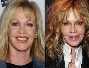 Melanie Griffith before and after plastic surgery 02