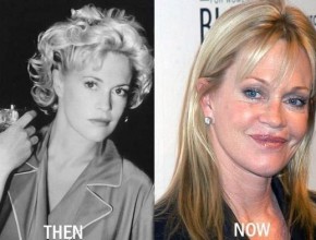 Melanie Griffith before and after plastic surgery