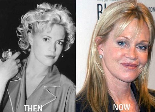 Melanie Griffith before and after plastic surgery