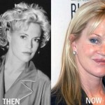 Melanie Griffith before and after plastic surgery 03