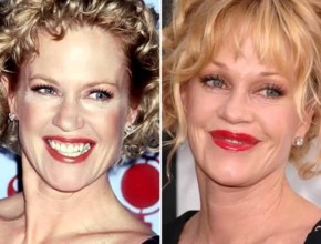 Melanie Griffith before and after plastic surgery 04