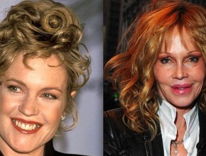 Melanie Griffith before and after plastic surgery