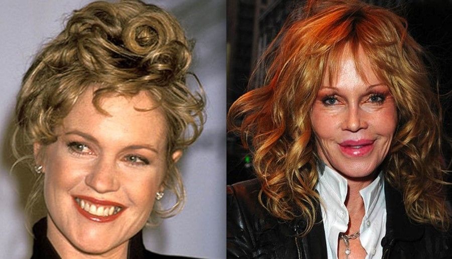 Melanie Griffith before and after plastic surgery